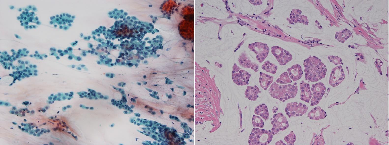 化生乳がんはどのように治療されますか?