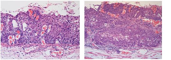 例1．食道癌の内視鏡的摘出 | 京都市立病院