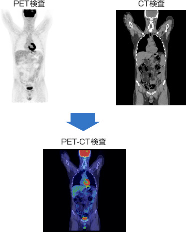 PET-CTのイメージ