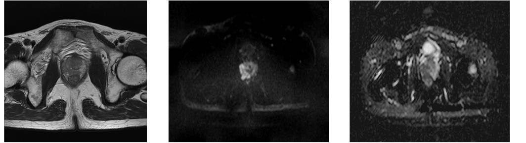 前立腺のMRI画像