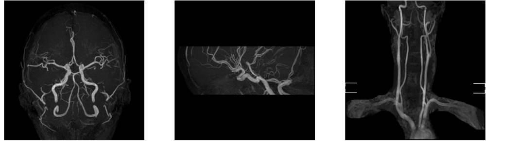 脳・頸動脈MRAのMRI画像