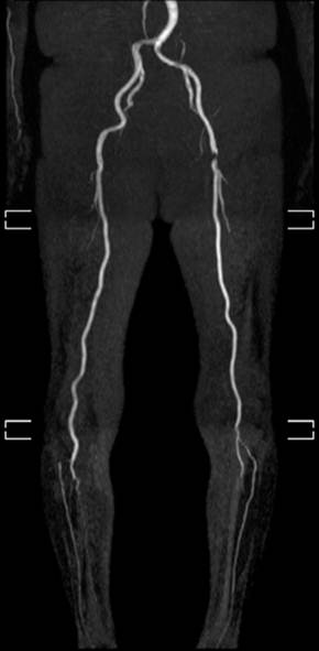 下肢動脈のMRI画像