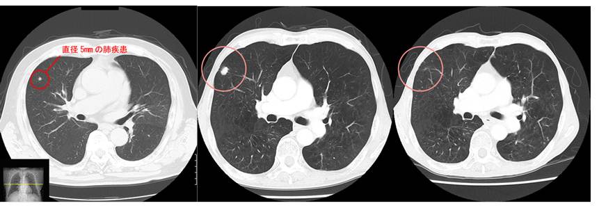 肺ドッグＣＴ画像