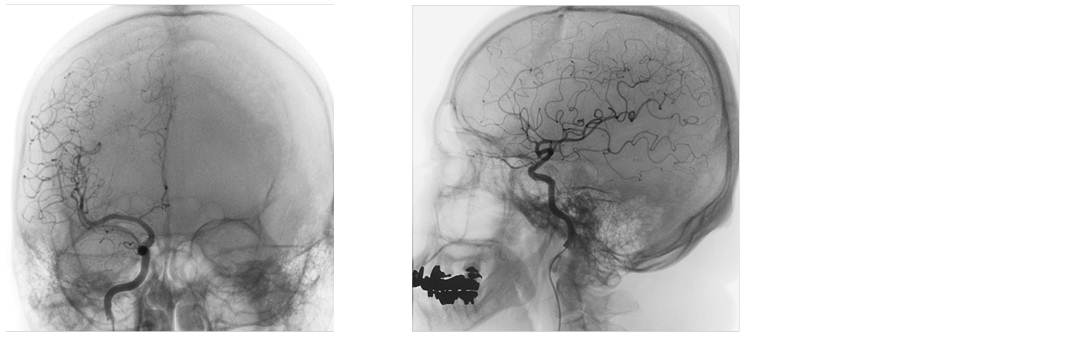 頭部血管造影画像