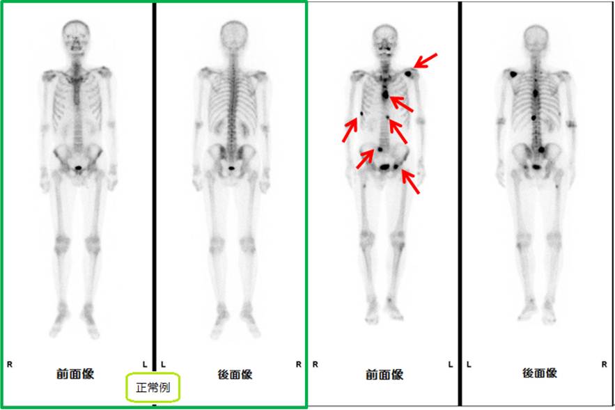 骨シンチグラフィのイメージ画像