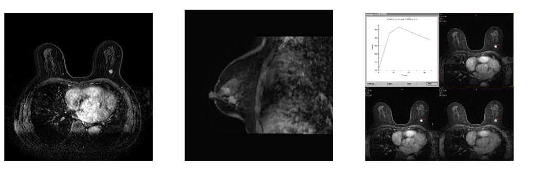 乳腺のMRI画像