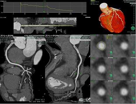冠動脈ＣＴ画像