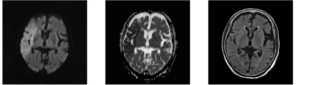 脳MRI検査の画像比較