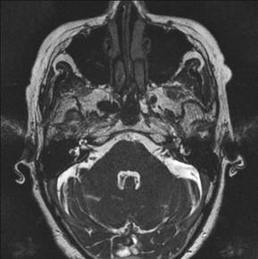 内耳・神経のMRI画像