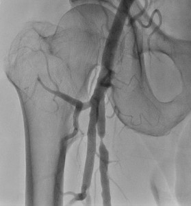 下肢動脈血管拡張術の画像1