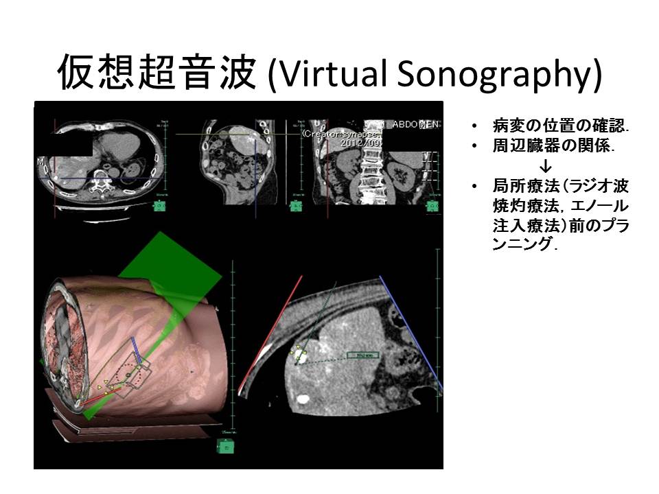 仮想超音波の画像