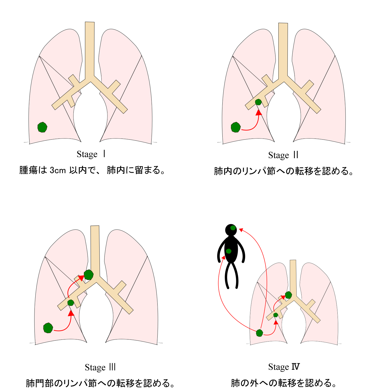 肺がんの病期 京都市立病院